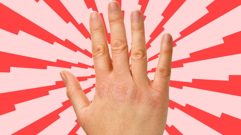 Handverzorging-Droge-handen-zorg-verpleging-kloofjes-schilfers