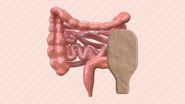 Margot-stoma