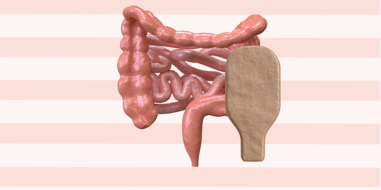 Margot-stoma